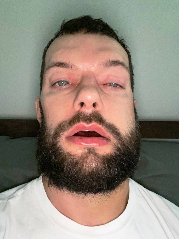 Finn Balor Recovering From Surgery